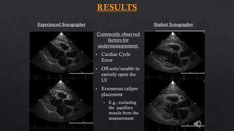 most accurate ejection fraction measurement